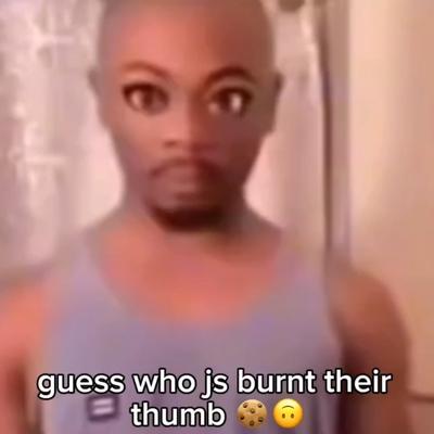 Guess who js burnt